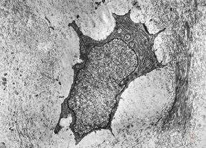 M,19y. | chondrocyte - chondrosarcoma - jaw M,19y. | chondrocyte - chondrosarcoma - jaw